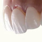 Are Veneers Worth The Cost? Find Out Here