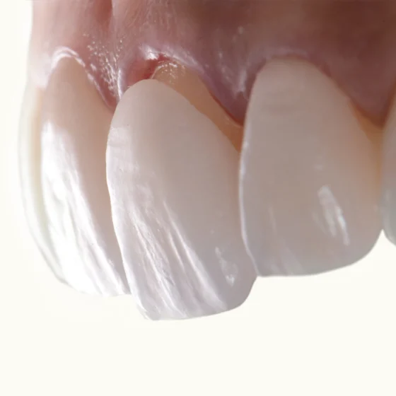 Are Veneers Worth The Cost? Find Out Here